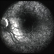 Recurrent Pseudotumor